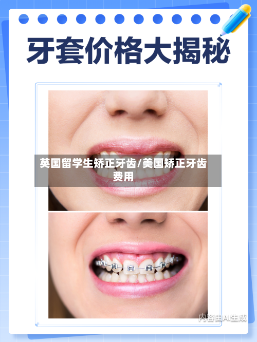 英国留学生矫正牙齿/美国矫正牙齿费用-第2张图片